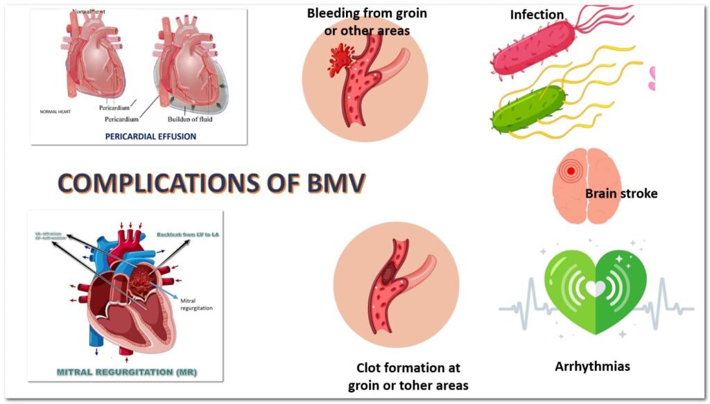 Balloon Mitral