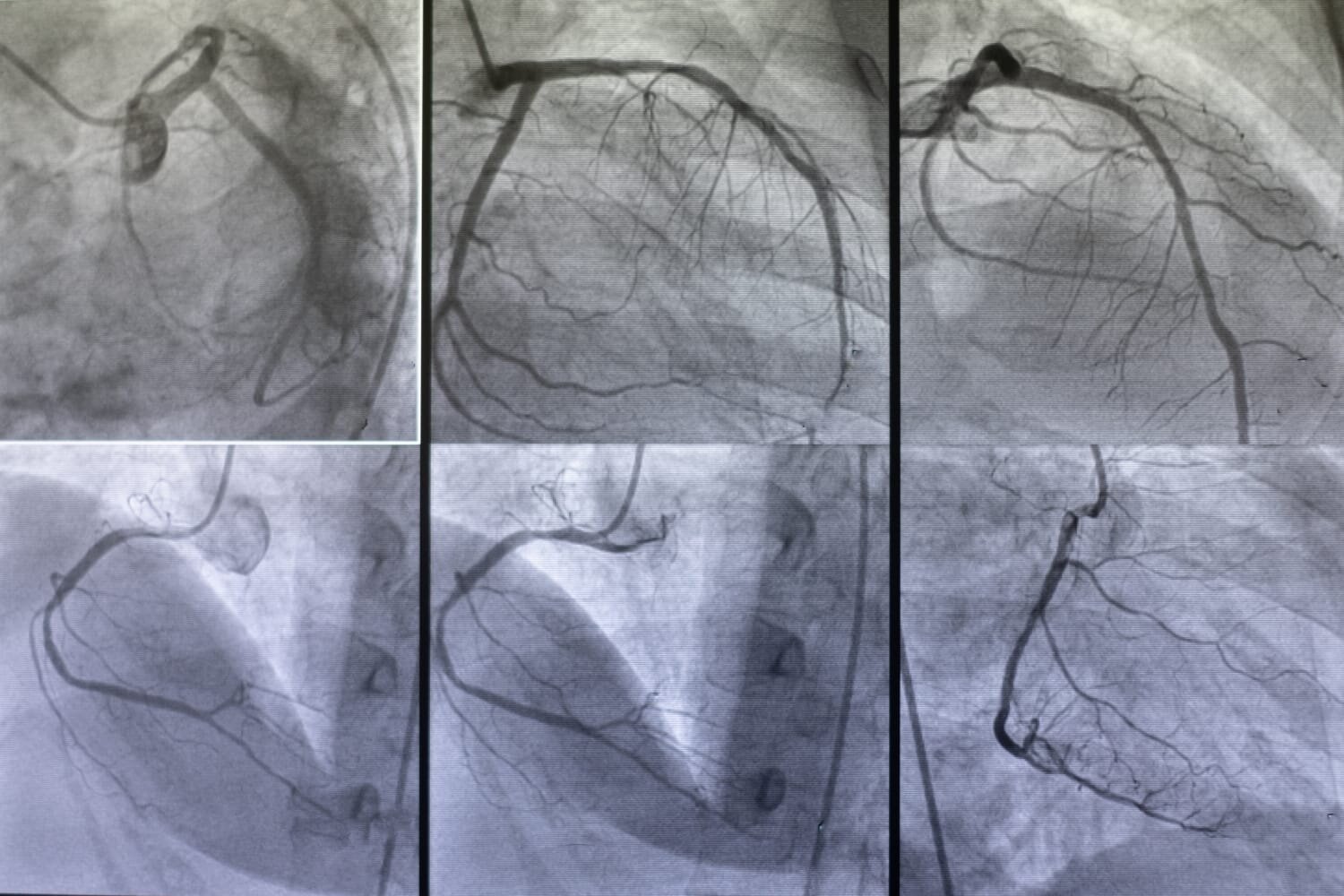 Coronary Angiography