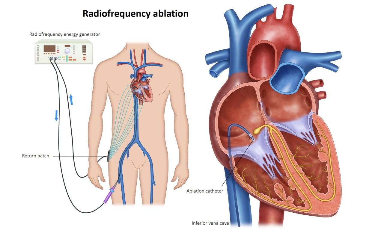 Electrophysiology Study