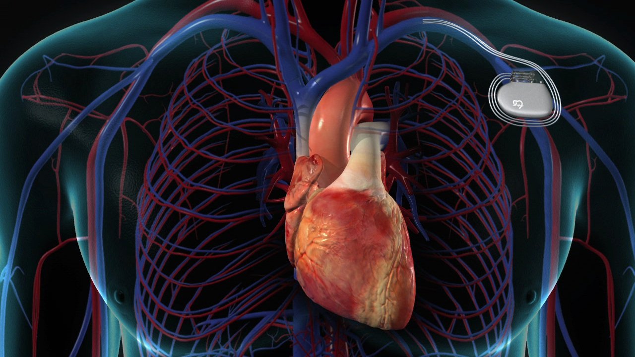 Pacemaker Implantation