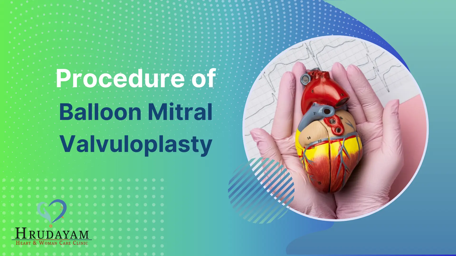 Understanding the Balloon Mitral Valvuloplasty Procedure