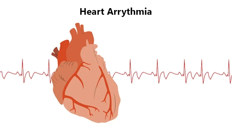 Know about EP Study and RF Ablation… A Novel treatment for Arrhythmia